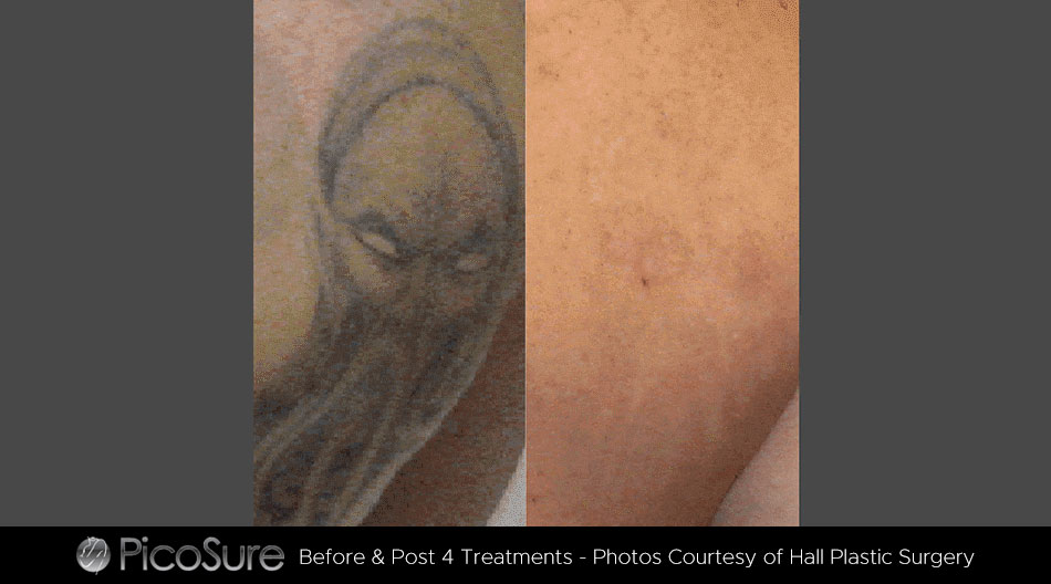 Laser Aesthetics & Expert Tattoo Removal located in Altoona, PA