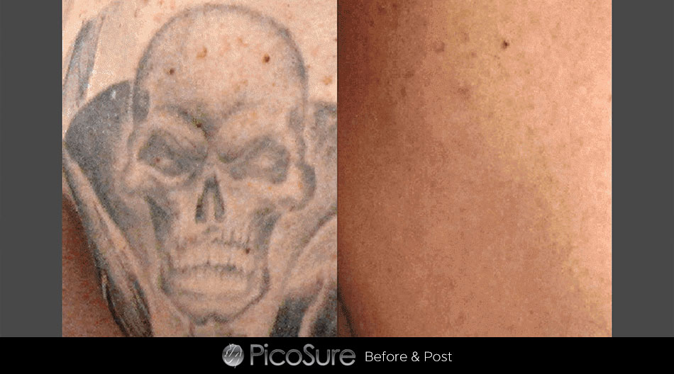Laser Aesthetics & Expert Tattoo Removal located in Altoona, PA