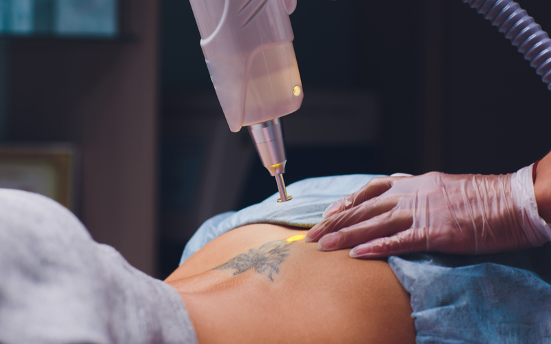 Close-up of expert tattoo removal process