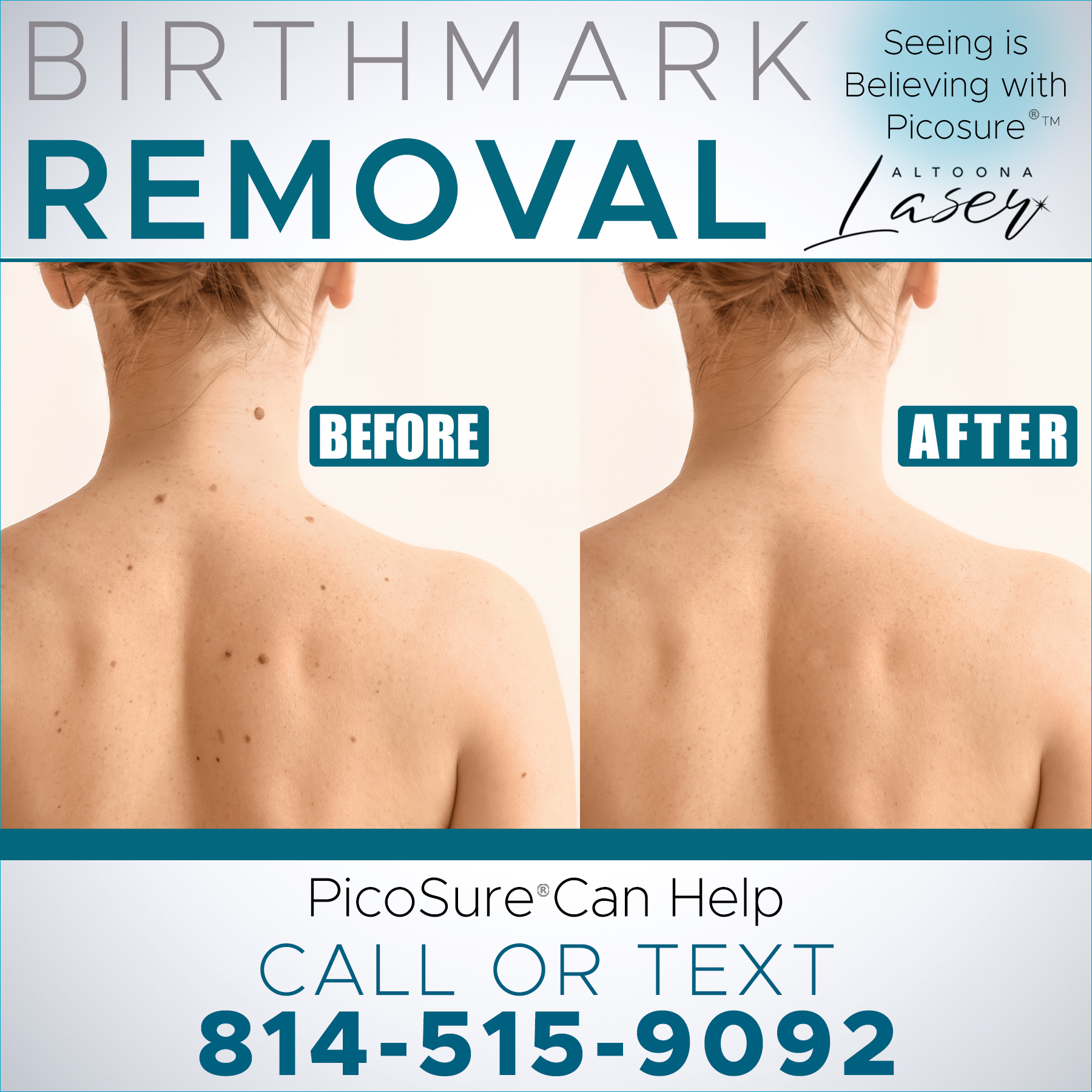 PicoSure- a safe, effective way to remove skin blemishes or tattoos.