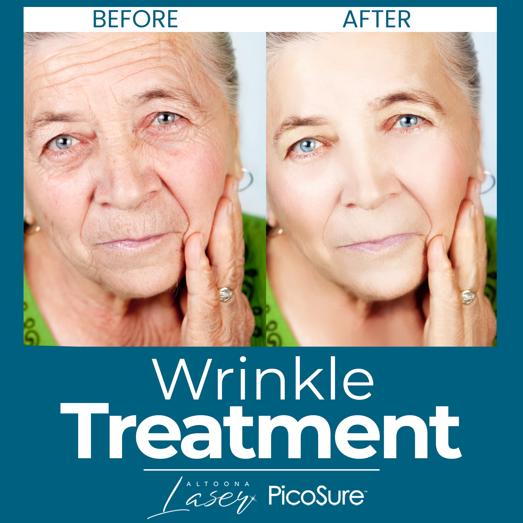 Wrinkle Treatment